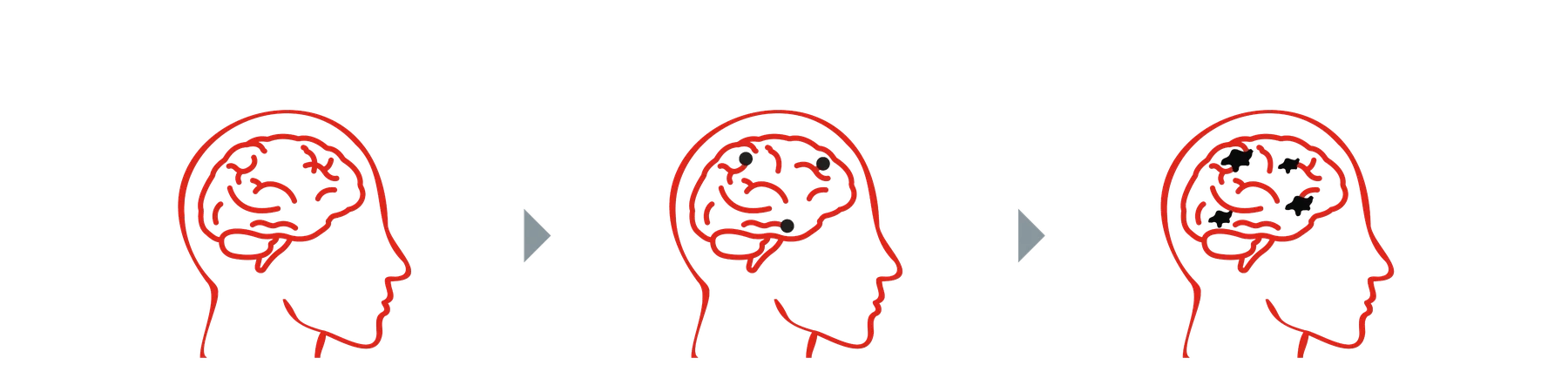 示意圖:大腦中的 β 類澱粉蛋白逐步聚集成斑塊